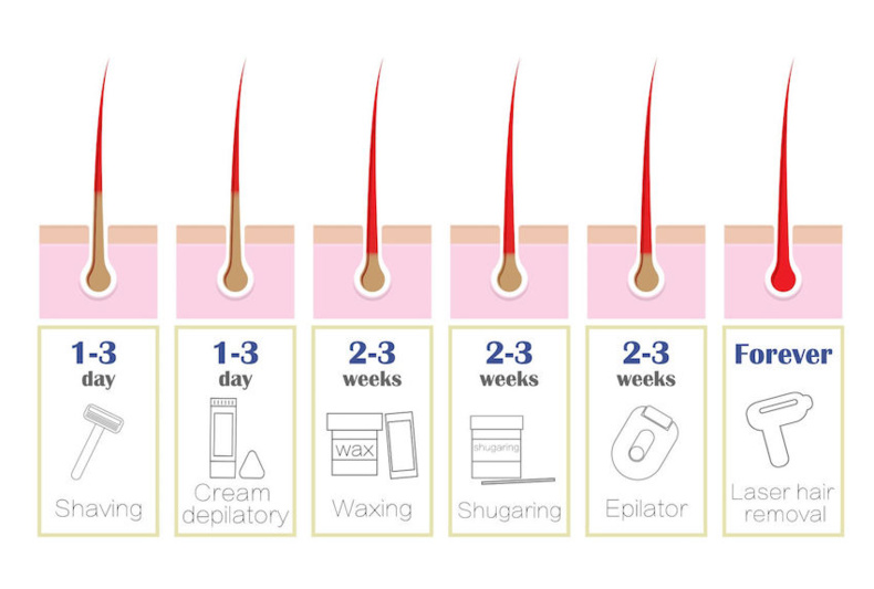 Centre Iremove - épilasion définitive laser à Ottignies (Brabant wallon) Centre Iremove - épilasion définitive laser à Ottignies (Brabant wallon)