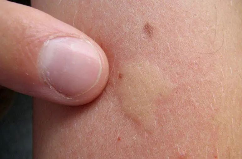 Astuce anti-moustique, Repérer moustique chambre, Éliminer moustique sommeil